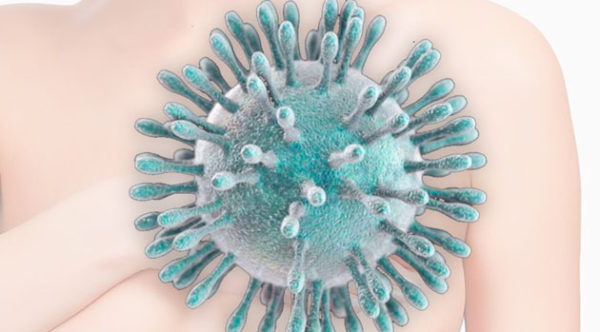 Nuevo coronavirus: Diagnóstico y tratamiento del cáncer de mama en pacientes con neumonía
